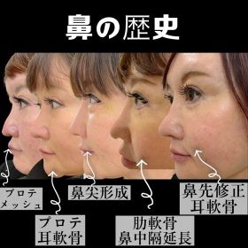 鼻整形の手術をこれまでに計6回行ったというmicaxさん